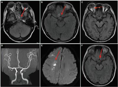 Fungal Endophthalmitis in a Case of Rhino-Orbito-Cerebral Mucormycosis: Successfully Treated With Amphotericin B Colloidal Dispersion